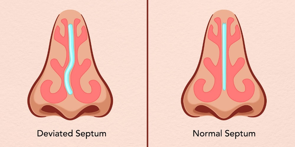 Septorhinoplasty