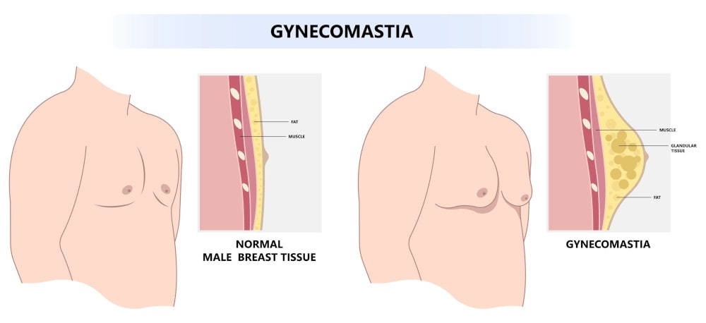 What is gynecomastia