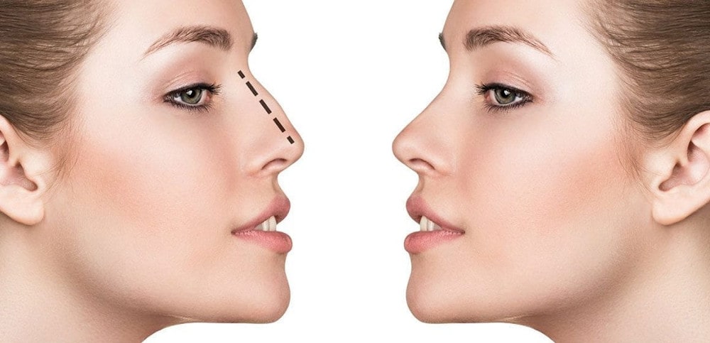 rhinoplasty
