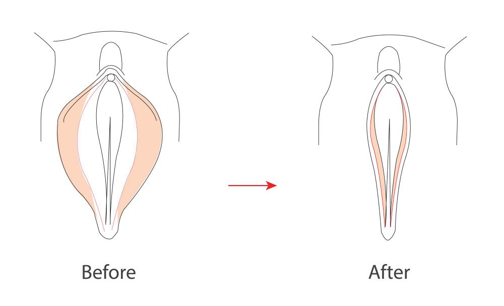Labiaplasty Before and After