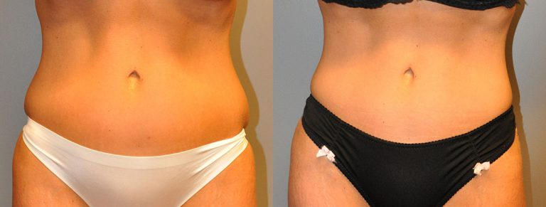 Reshaping the Body: Liposuction Procedure Outcome Revealed
