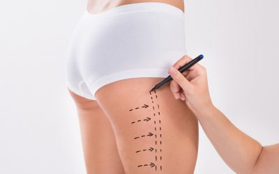 Which Thigh Lift For best result?