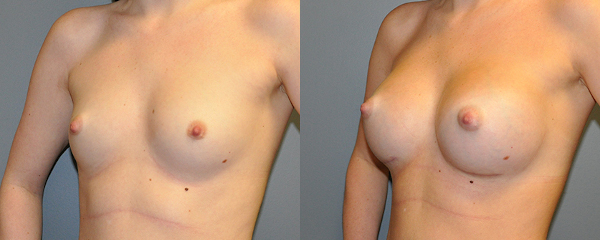 Skillful execution: Breast implant procedure