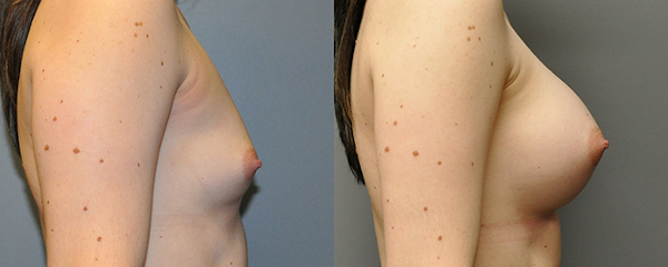 Subtle enhancements with breast augmentation