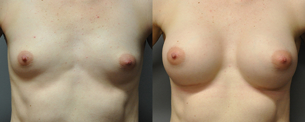 Innovative techniques in breast augmentation operation