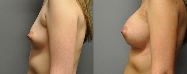 Artful mastery: Breast implant surgery