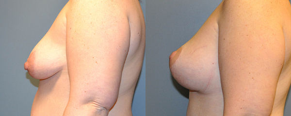 Artful techniques in breast augmentation