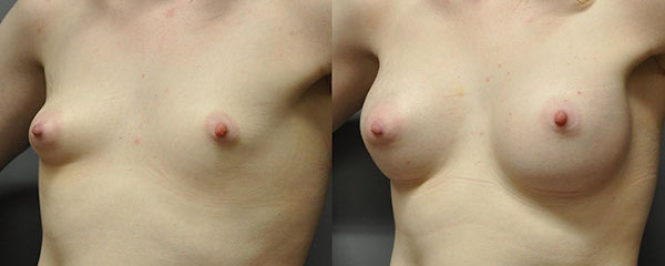 Balancing proportions: Breast asymmetry correction