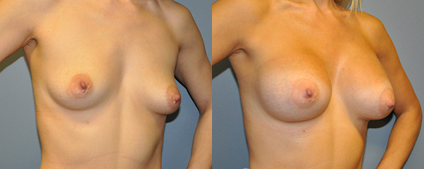 Harmonizing contours: Correcting breast asymmetry