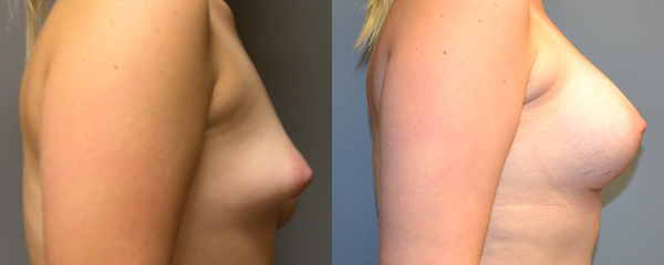 Crafting symmetrical beauty: Breast asymmetry treatment