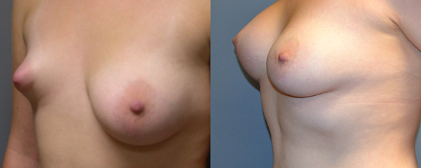 Precision techniques in asymmetry correction