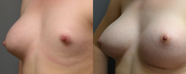 Empowering transformations: Breast asymmetry journey