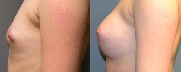 Restoring balance: Breast asymmetry correction