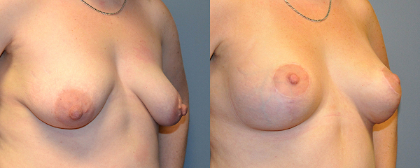 Youthful contours with breast lift