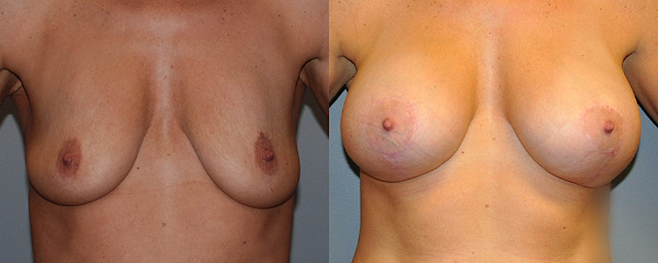 Revitalizing lift for the breasts
