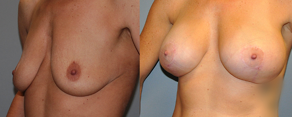 Elevated confidence with breast lift