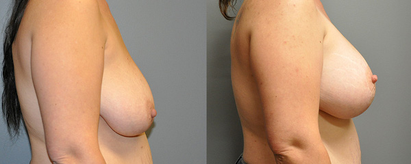 Graceful uplift with mastopexy