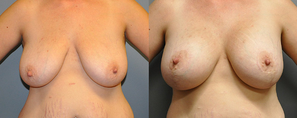 Natural-looking breast lift results