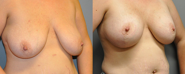 Enhanced femininity through mastopexy