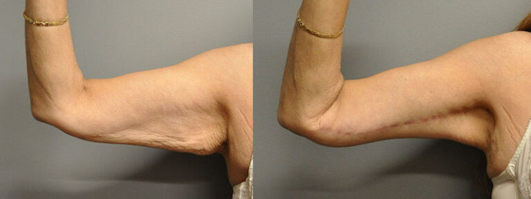 Sculpting sleek arms: Arm lift procedure