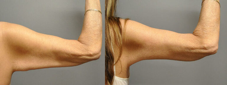 Refining upper body contours: Arm lift surgery