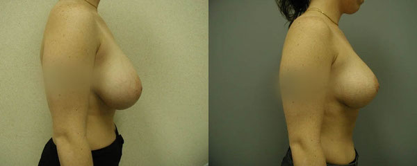 Sculpting natural contours: Breast reduction transformation