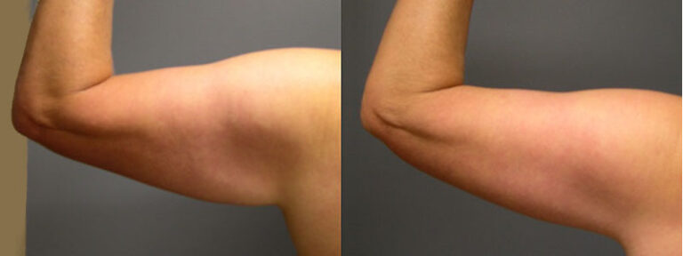 Crafting confidence: Arm lift transformation