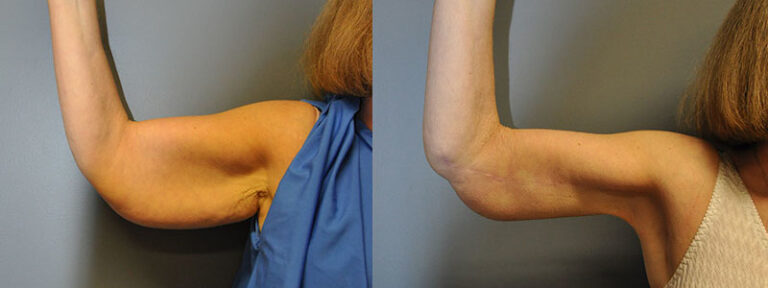 Precision techniques in arm lift procedure