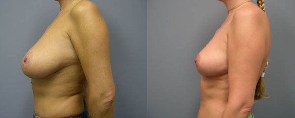 Precision techniques in mammoplasty procedure