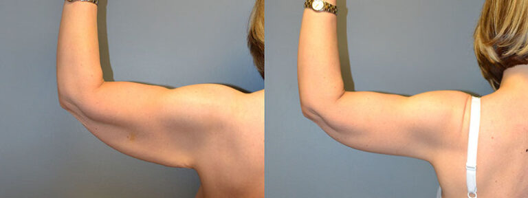 Empowering transformations: Arm lift surgery