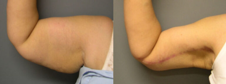 Customized care for arm contouring: Arm lift