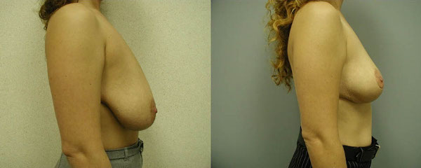 Reclaiming comfort: Breast reduction surgery