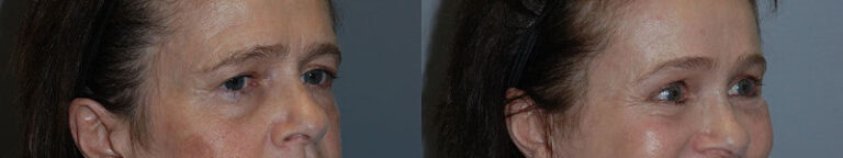 Elevating beauty: Brow lift procedure