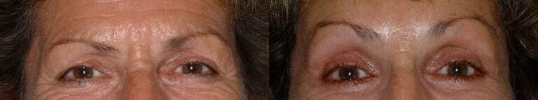 Precision techniques in brow lift procedure