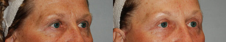 Empowering transformations: Brow lift journey