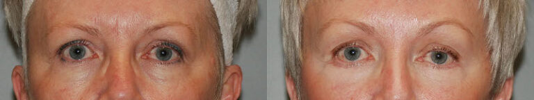 Artful precision in brow lift surgery