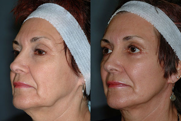 Enhancing natural features: Face lift process