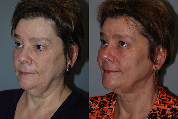 Enhancing facial volume: Facial fat grafting procedure