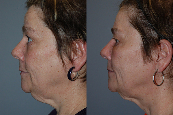 Crafting youthful radiance: Facial fat grafting transformation