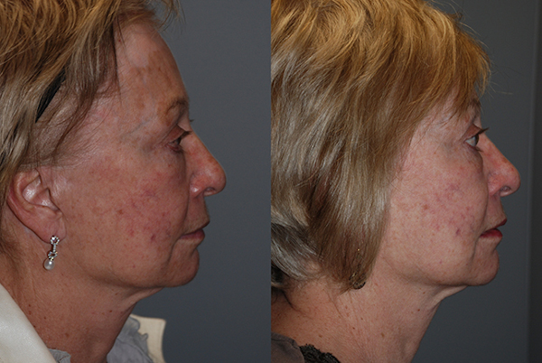 Precision techniques in facial fat grafting procedure