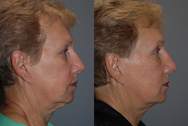 Empowering transformations: Facial fat grafting journey