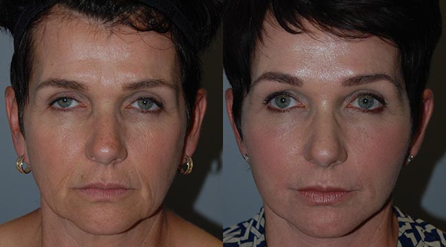 Transforming skin with Renuvion J-Plasma