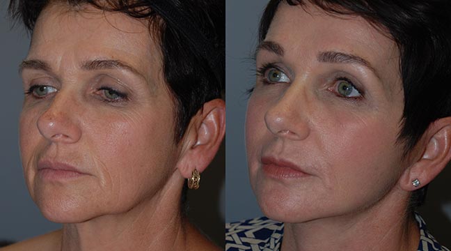 Elevating beauty with Renuvion J-Plasma treatment