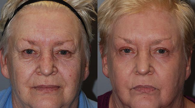 Revolutionizing rejuvenation: Renuvion J-Plasma technology