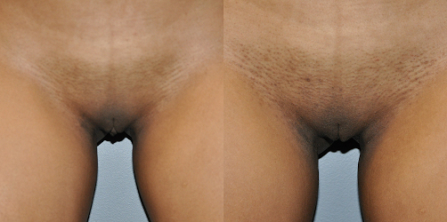 Refining intimate contours: Labiaplasty surgery