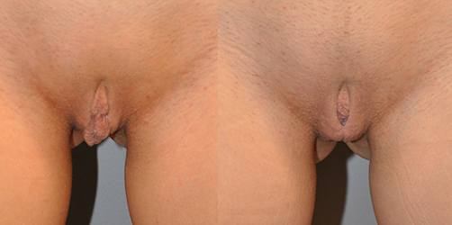 Customized solutions for intimate rejuvenation: Labiaplasty