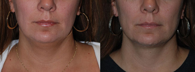 Sculpting sleek necklines: Neck liposuction procedure