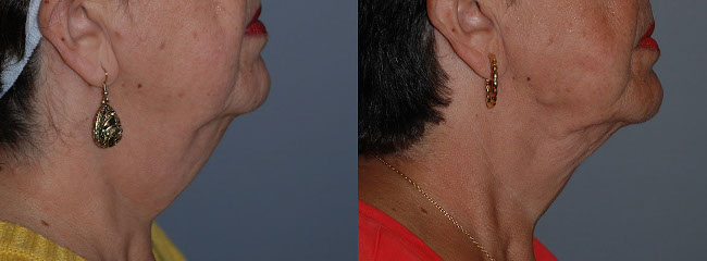 Refining neck contours: Liposuction surgery underway