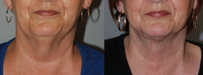 Crafting youthful profiles: Neck liposuction transformation