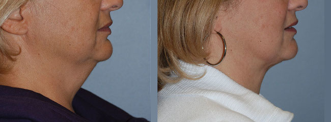 Precision techniques in neck liposuction procedure